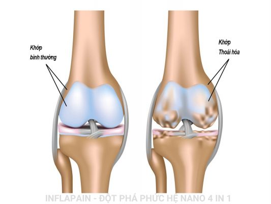 Điều Trị Thoái Hóa Khớp Gối