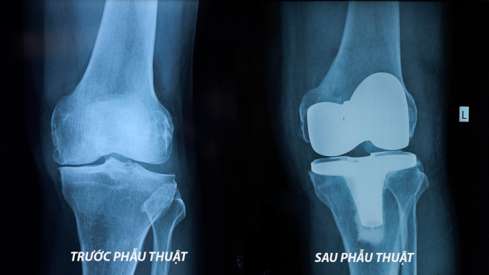 Phẫu Thuật Thay Khớp Gối Nhân Tạo