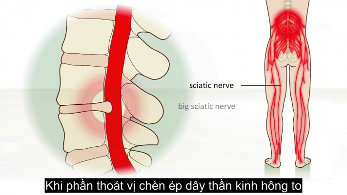 Thoát Vị đĩa đệm Chèn Dây Thần Kinh Có Nguy Hiểm