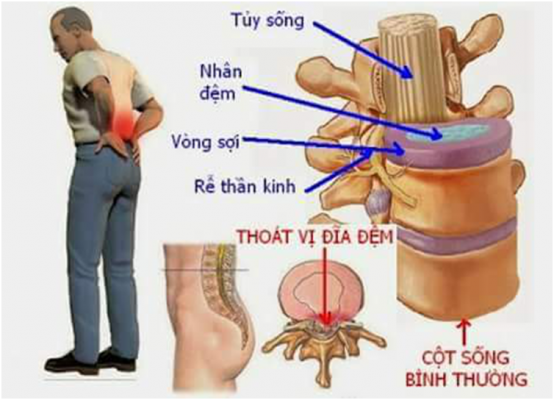 Thoát Vị đĩa đệm Thắt Lưng