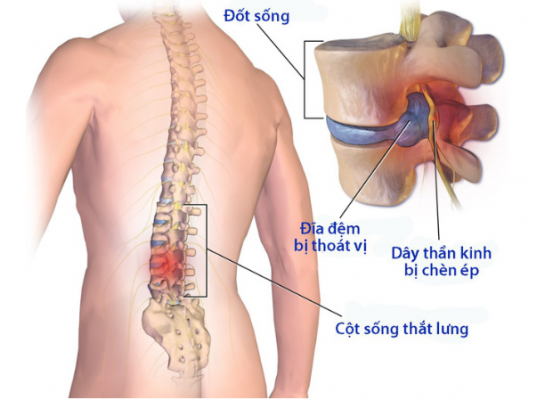 Thoát Vị đĩa đệm Và Gai Cột Sống